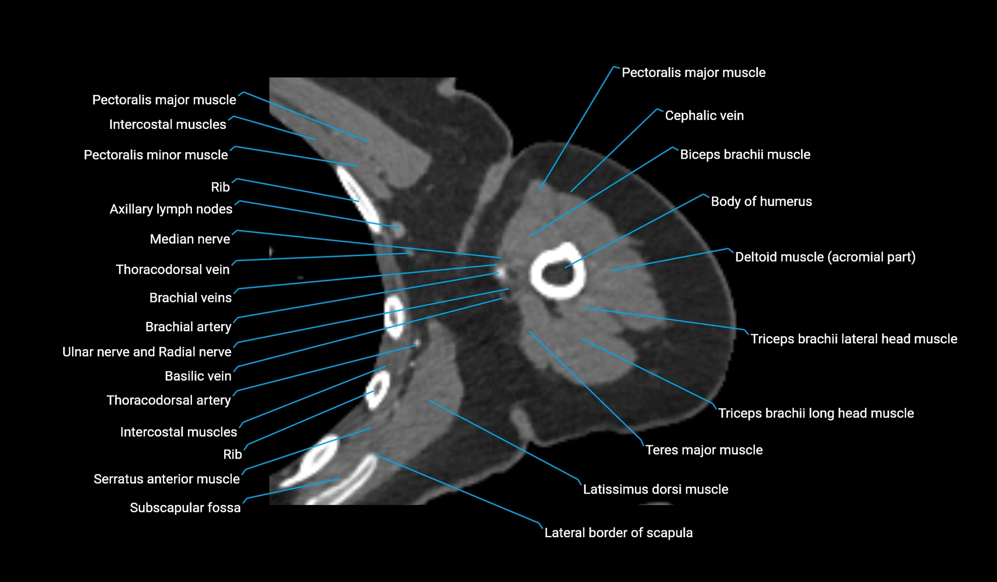 CT upper arm axial  cross sectional anatomy labelled radiology image -00168.webp